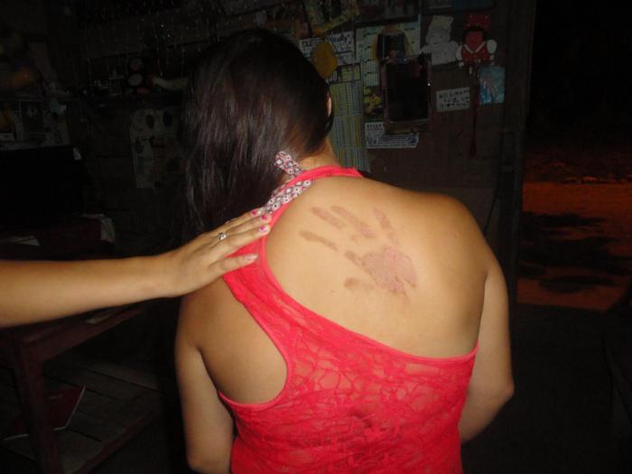 Extraña aparición de una marca de mano en espalda de joven