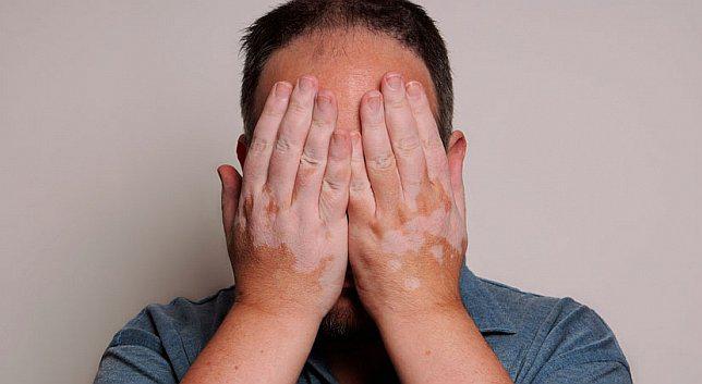 Cuidado el estrés y depresión pueden provocar vitiligo