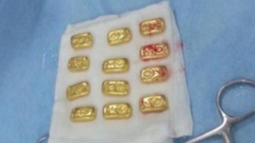 India: Hombre escondía 12 barras de oro en el vientre