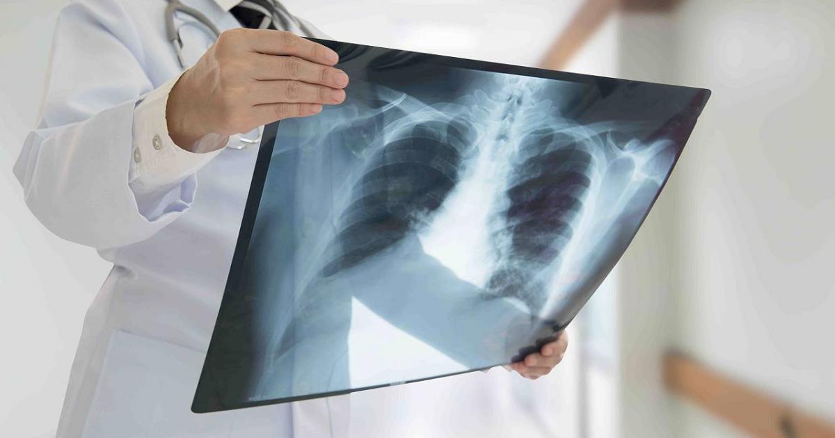 Ministerio de Salud implementa acciones de control y detección de casos de TBC durante la pandemia del COVID-19 (foto referencial)