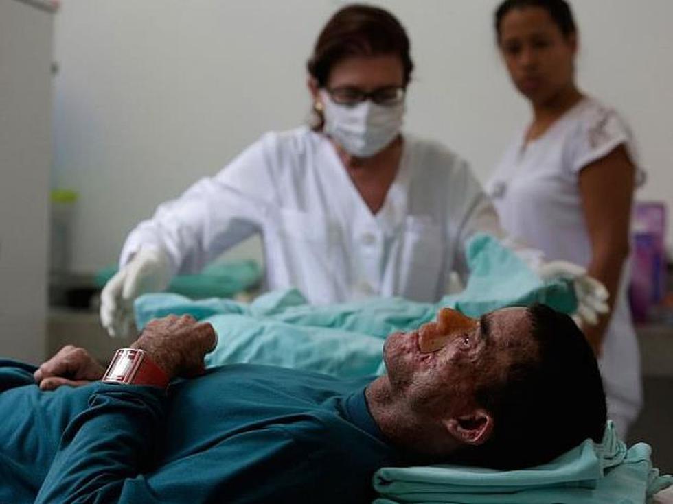 Brasil: Investigan enfermedad que deja sin piel a los habitantes de un pueblo