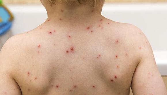 La varicela es una enfermedad contagiosa. (Foto: IStock)