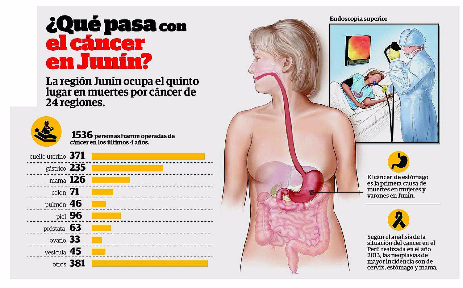 El ​90% de pacientes llega con cáncer avanzado