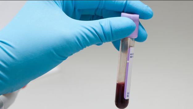 Desarrollan prueba de sangre que predice aparición del temido alzheimer