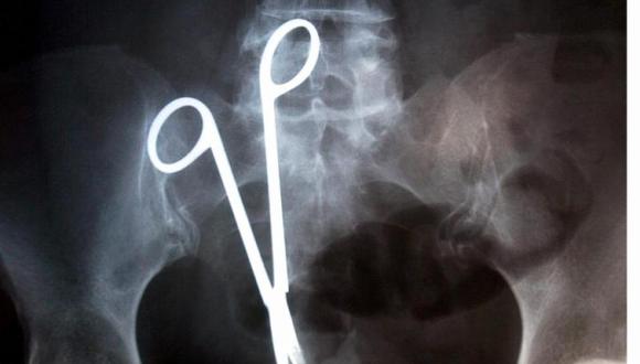 Mujer vivió con tijeras en su vientre por error médico