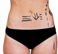 Reino Unido: La cirugía estética de vagina se pone de moda