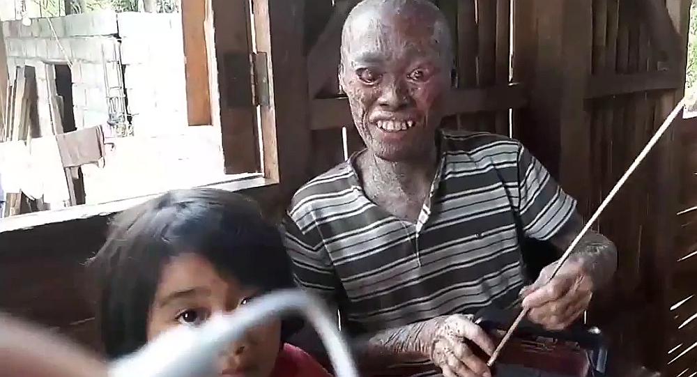 La impactante vida del hombre pez de Filipinas y su lucha por salir adelante [VIDEO]