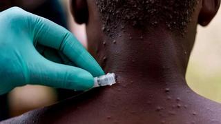 UE aprueba la vacuna contra la viruela del mono de farmacéutica Bavarian Nordic