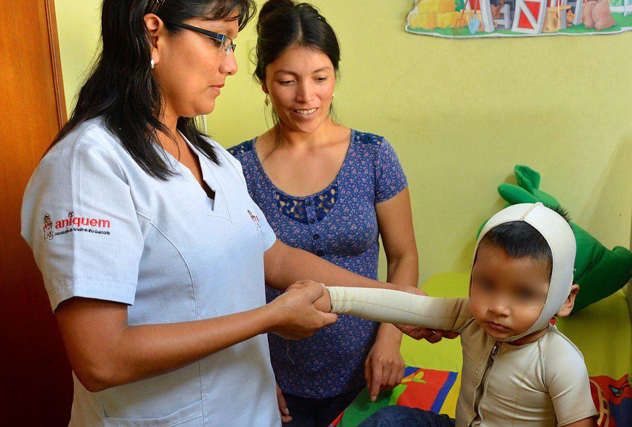 Operarán gratis a niños víctimas de quemaduras y labio leporino