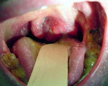 Sexo oral y no tabaco causa # 1 de cancer de garganta