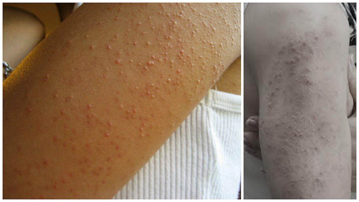 ¿Tienes granos en los brazos? ¡Cuidado! Puede ser señal de enfermedad