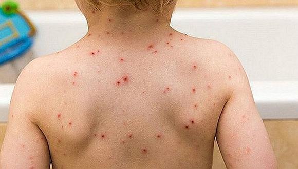 Piura: Promueven campaña para vacunar a niños contra la varicela e influenza