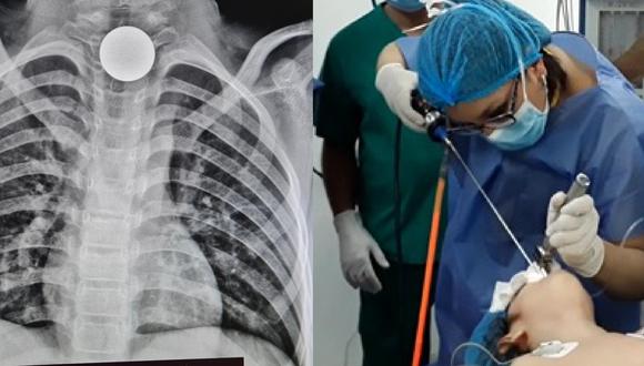Los médicos procedieron a la extracción del metal mediante una endoscopia esofágica. (Foto: Difusión)
