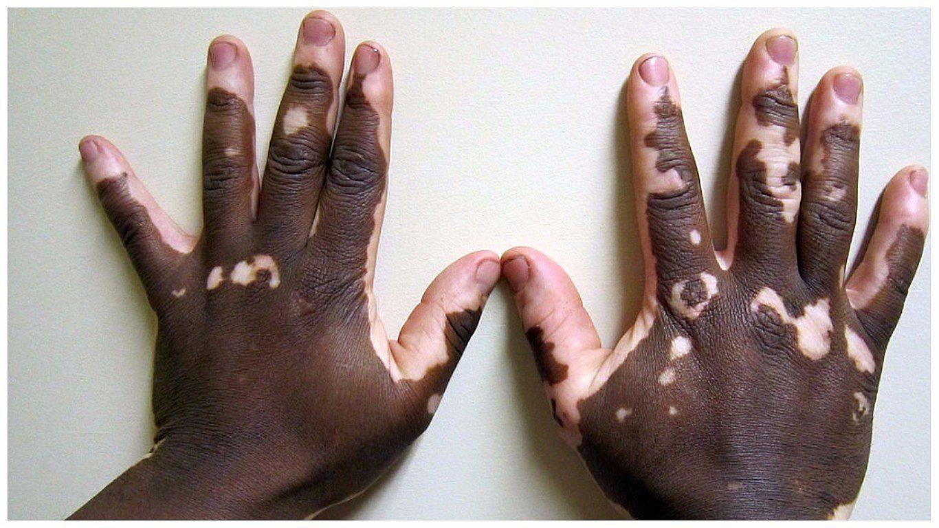 Día Mundial del Vitiligo: conoce más de este mal que no solo afecta la piel