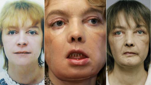 Primer paciente de transplante de cara cuenta cómo vive ahora