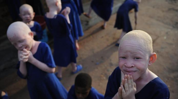 Horror los albinos de Tanzania están siendo violentamente mutilados