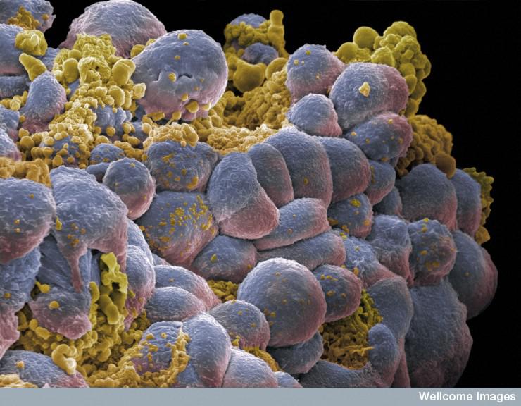 El cáncer obedece más seguido a la "mala suerte" que a causas genéticas