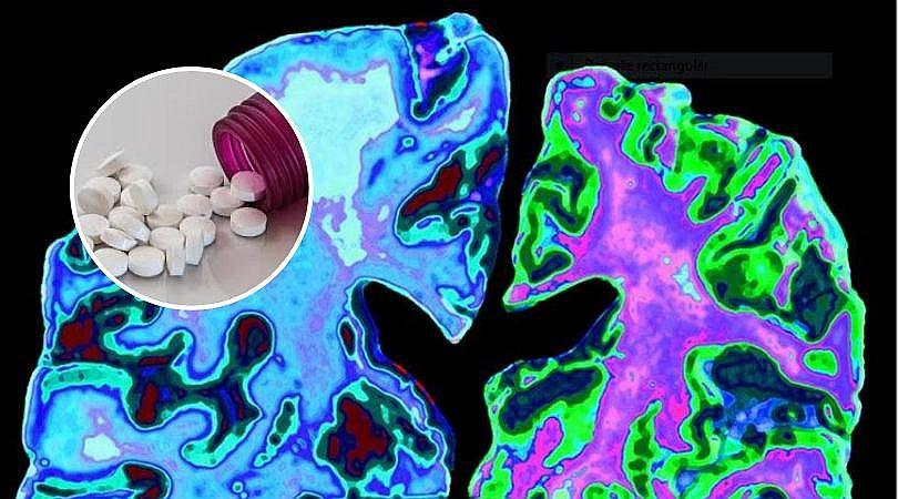 Industria farmacéutica esconde que uno de sus remedios reduciría el alzheimer
