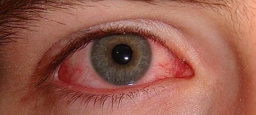 Zika provoca inflamación dentro de los ojos