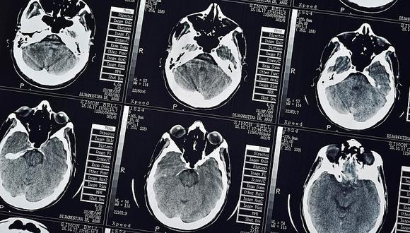 Una mujer descubre que era una tenia y no un tumor lo que se alojaba en su cerebro