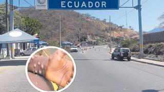 Piura: Urge controlar la frontera por viruela del mono