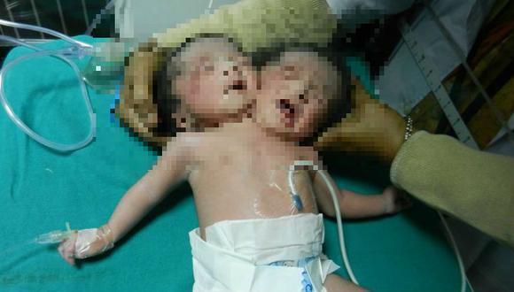Bebé con dos cabezas nació en la India