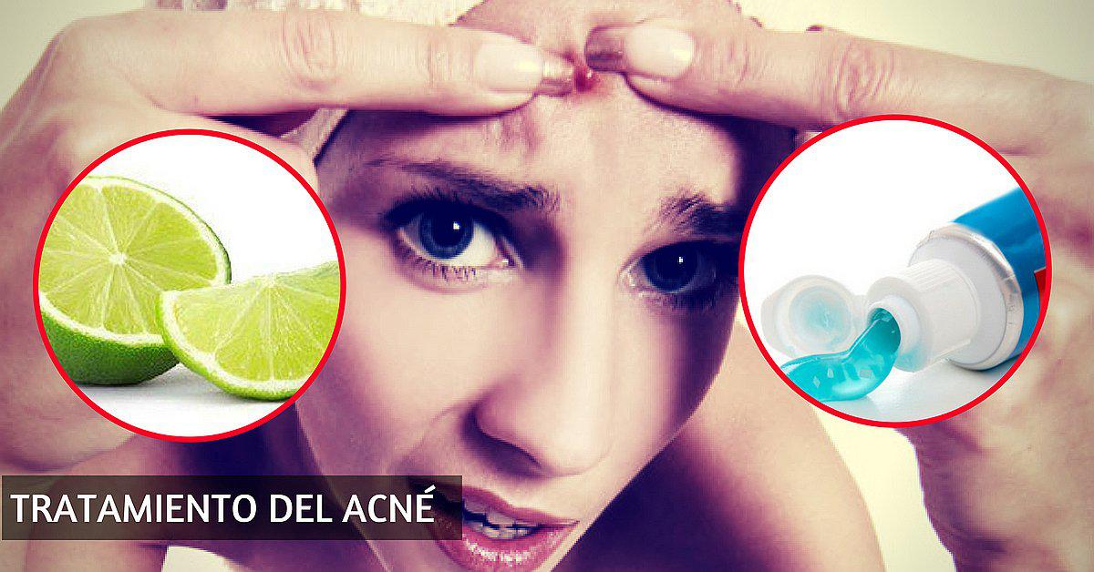 Remedios caseros para el acné rápidos y efectivos