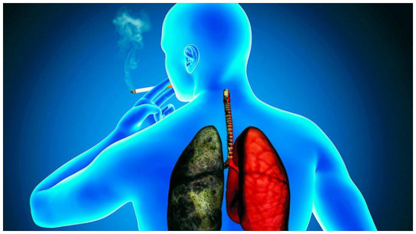 Cáncer de pulmón cuesta 1,35 billones de dólares anuales a América Latina