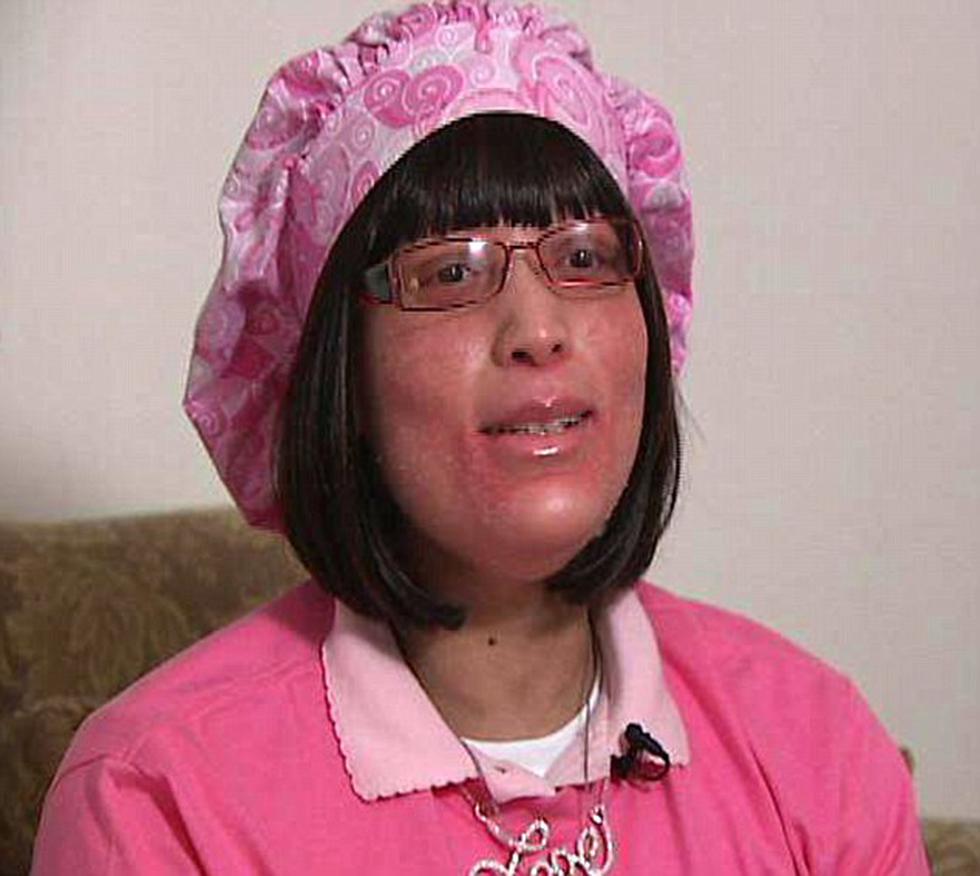 Extraño mal que hace crecer uñas en vez de pelo deja atónitos a médicos