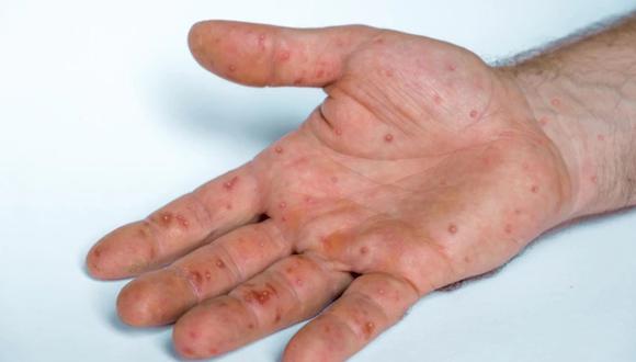 Es importante recordar que siguen los casos reportados de Covid-19 e Influenza. Se debe reforzar el uso de mascarillas, lavado de manos, distanciamiento y vacunación.
