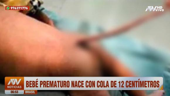 Bebé prematuro causa asombro en médicos brasileños. (Captura: ATV)