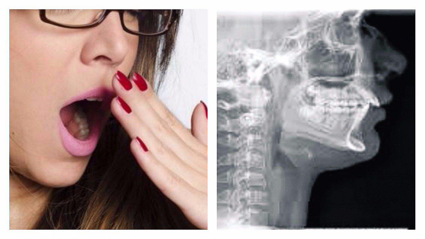 Huancayo: Universitaria bosteza fuerte y termina con mandíbula luxada