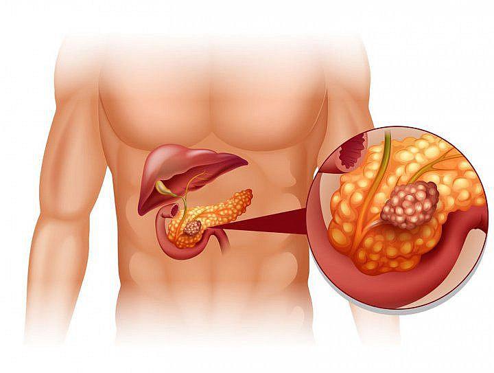 Sepa por qué los hombres son más propensos a padecer de cáncer de páncreas