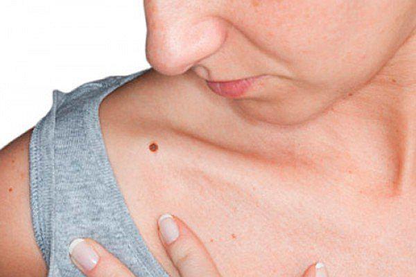 ​Conozca las señales que podrían indicar un riesgo de cáncer de piel