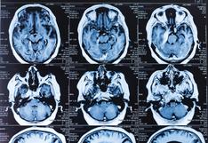 Unos 40 pacientes con males al cerebro detectan cada año en hospital Carrión en la región Junín