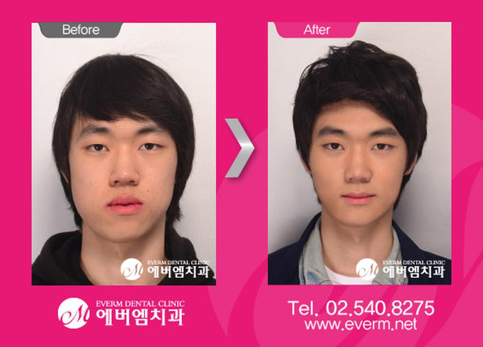 Estos son los radicales cambios de las cirugías estéticas en Corea (FOTOS)