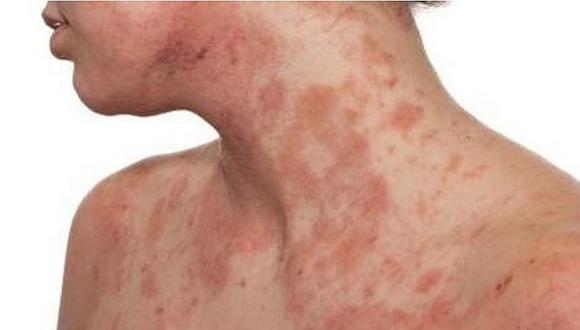Dermatitis atópica: la enfermedad de la piel que genera depresión y ansiedad