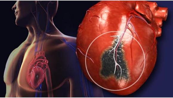 ​El infarto cardíaco produce alrededor de 20 mil fallecimientos al año