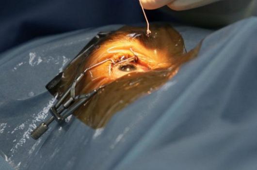 Paciente con primer trasplante de retina con células madre evoluciona favorablemente