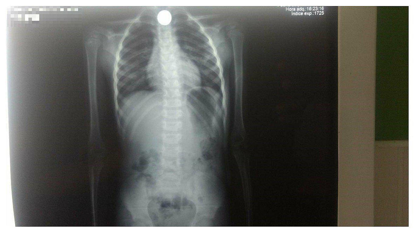 Un niño de seis años se traga una moneda y médicos le salvan la vida 