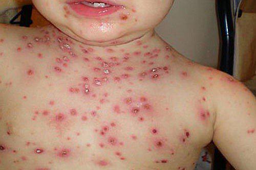 Piura: Tres muertos por varicela en lo que va el año en la región