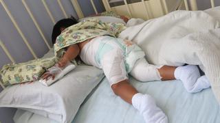 Menores sufren quemaduras por accidentes en sus hogares y terminal en el hospital