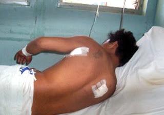 Joven salva de morir luego que le clavaran cuchillo en el hombro