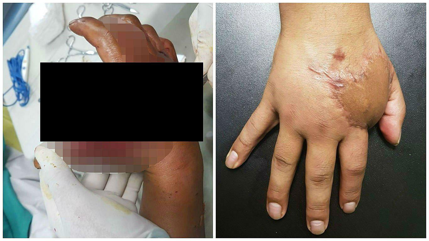 Recupera la mano gracias a injerto de piel de su propio abdomen (VIDEO)