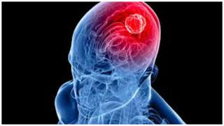 Especialista alerta que cáncer de cerebro está asociado a dolor de cabeza intenso y vómitos