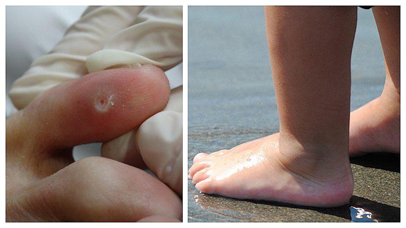 Verrugas en los pies: muchos las confunden con los callos  