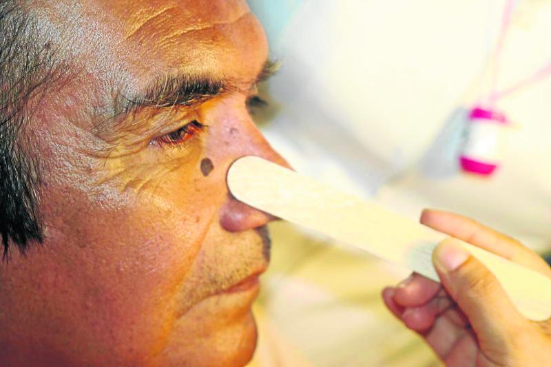 Dos de Mayo realiza hoy despistaje de cáncer de piel