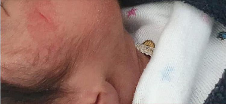 ​EsSalud empezó auditoría médica por corte en el rostro de recién nacida