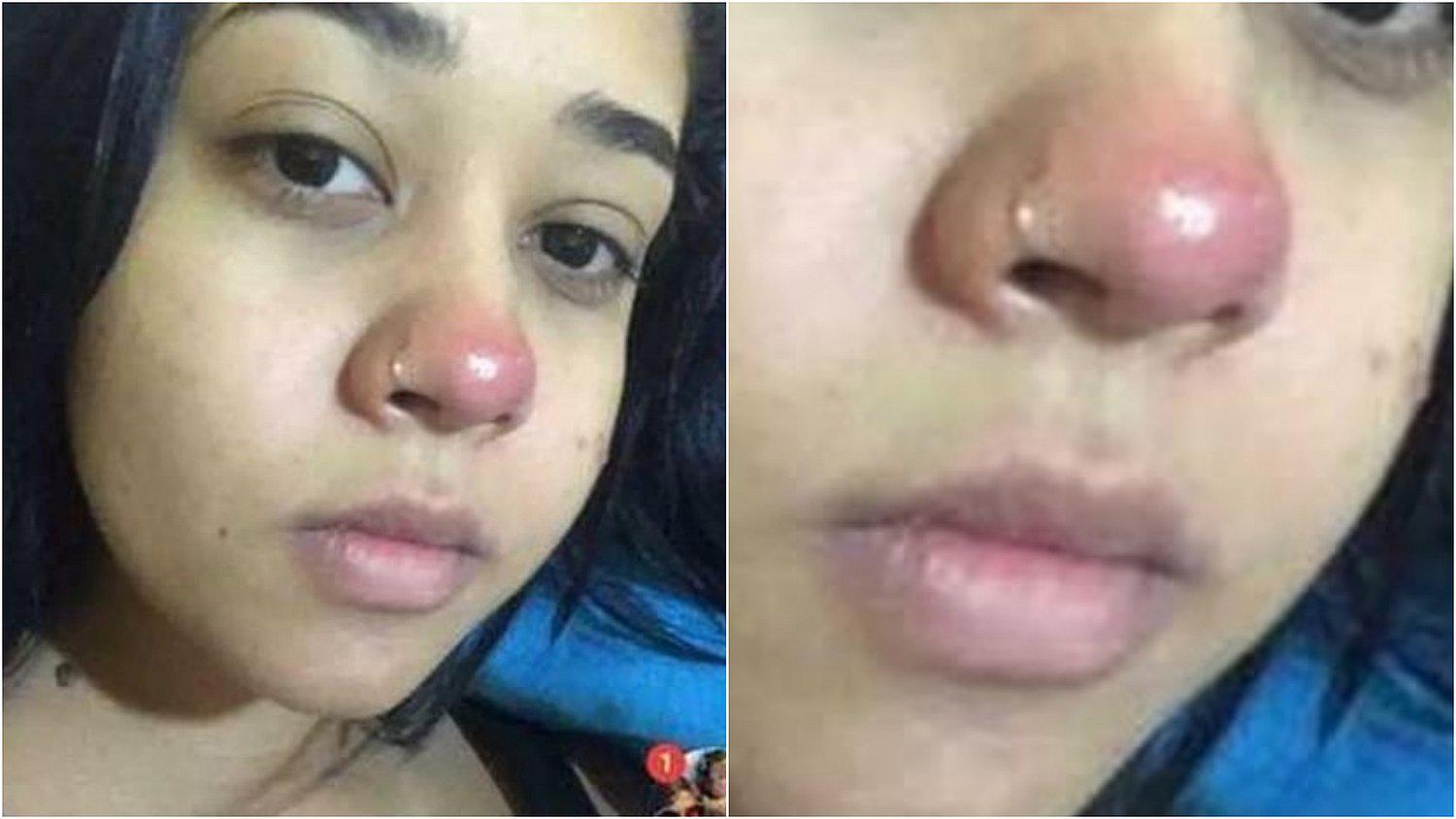 Mujer queda parapléjica tras ponerse un piercing en la nariz 
