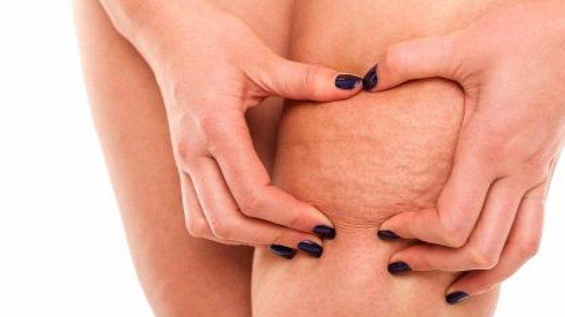 Cinco mentiras que las personas suelen creer sobre la Celulitis 